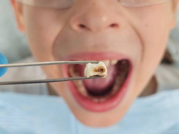 Emergency Dental Filling Replacement in MD